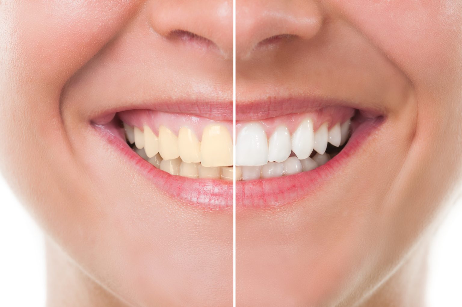 What is Dental Bleaching: Procedure, Cost, Effectiveness & More - Today ...